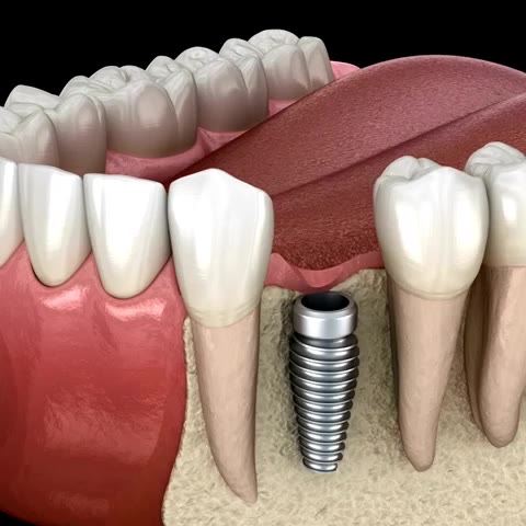 Implantes dentários